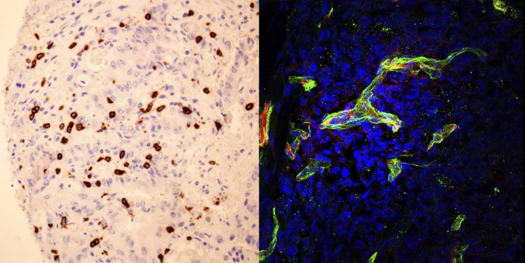 Izquierda: Linfocitos citotóxicos (en marrón) infiltrando un tumor colorectal con altos niveles de SOD3. Derecha: Células tumorales (cuyos núcleos se muestran en azul) con los vasos sanguíneos que los irrigan (en rojo) donde se observa la proteína de la membrana basal (en verde) que permite que los linfocitos accedan al tumor. / CNB